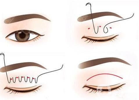 埋線法做雙眼皮費用是多少?