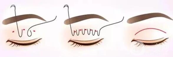 割雙眼皮過(guò)程大概需要多長(zhǎng)時(shí)間?