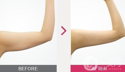 全身吸脂減肥價格