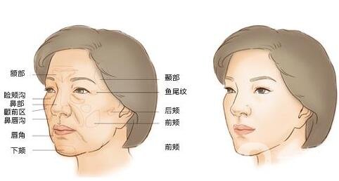 面部脂肪填充吃什么成活率高？