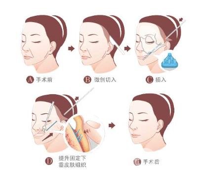 下筋膜懸吊祛皺術(shù)怎么操作的？*果嗎？