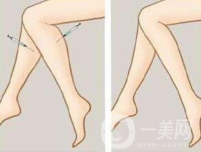 *瘦小腿一般多少錢？