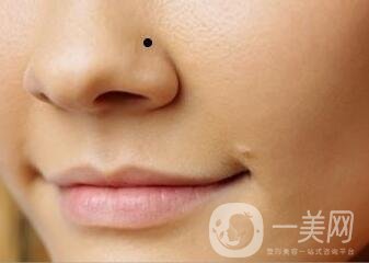 鼻翼缺損矯正*大嗎？要多少錢？