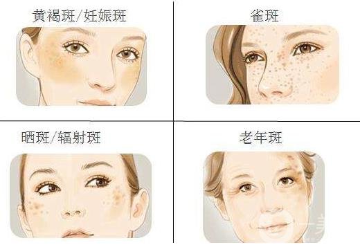 激光祛斑*果怎么樣?會(huì)復(fù)發(fā)嗎?