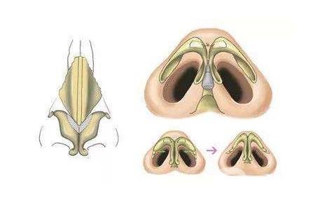 鼻頭肥大縮小術(shù)是持久*的嗎？