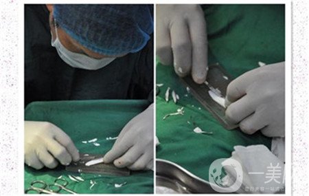 膨體材料隆鼻有哪些優(yōu)勢(shì)呢?