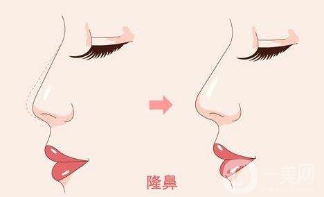 隆鼻手術(shù)會對我們的身體有危害嗎?