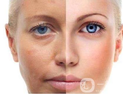 激光祛斑好嗎？需要打麻藥嗎？