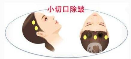 小切口除皺術(shù)后恢復(fù)過(guò)程是怎樣的？