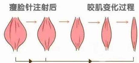 咬肌切除手術(shù)和*信息介紹些?