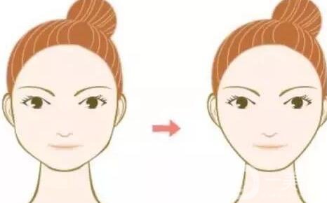 咬肌切除手術(shù)和*信息介紹些?