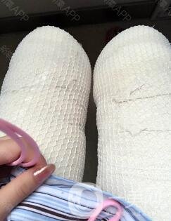 360度環(huán)形吸脂