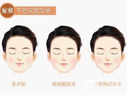 下頜角手術(shù)術(shù)后護(hù)理要注意哪些？