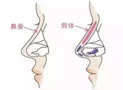 硅膠隆鼻假體取出術后護理注意事項有哪些呢?