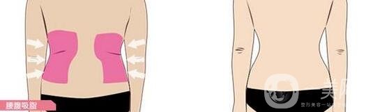 環(huán)形吸脂價格貴不貴?一般多少錢?