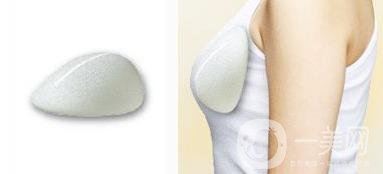 水滴型假體隆胸