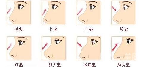 人工骨粉隆鼻*嗎?對(duì)人體有害嗎?