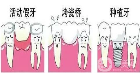 鑲牙的種類各有什么優(yōu)缺點(diǎn)