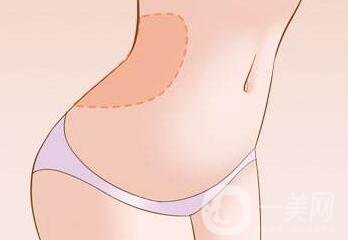 腹壁整形多少錢？費用詳細解說