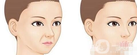 去鼻唇溝多少錢?哪種材料便宜些?