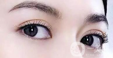 吸雕雙眼皮是*的嗎?缺點有哪些