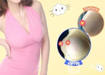 娜高豐胸假體好不好？需要多少錢？