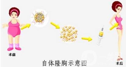 自體隆胸手術(shù)失敗修復(fù)注意事項(xiàng)