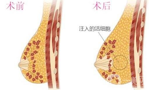 自體細胞豐胸*果自然嗎？要恢復(fù)多久？