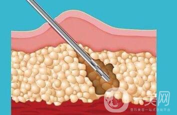 360度環(huán)形吸脂疼不疼？是全麻嗎？
