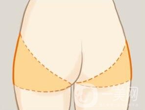 360度環(huán)形吸脂疼不疼？是全麻嗎？