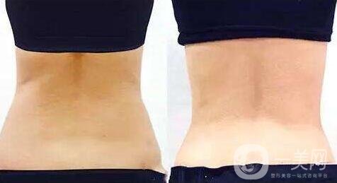 360度吸脂減肥是指環(huán)吸還是水動(dòng)力？