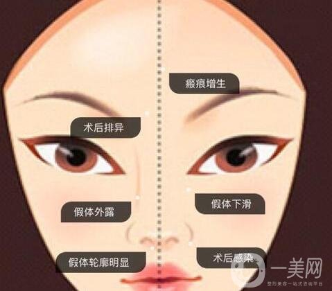 墊高鼻子的風(fēng)險有多大?后遺癥有哪些?