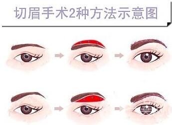 切眉除皺術(shù)要多少錢?*果好嗎?