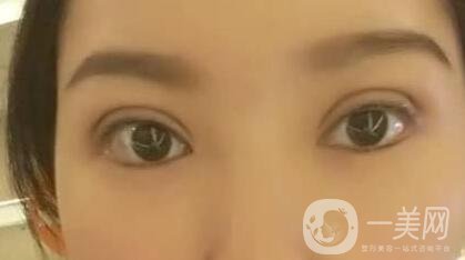 雙眼皮手術(shù)