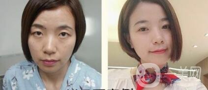 雙眼皮手術(shù)