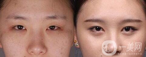 做雙眼皮手術(shù)