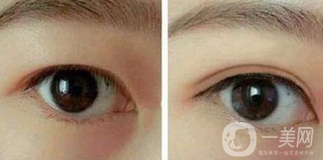 做雙眼皮手術(shù)