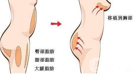 自身脂肪移植隆胸術(shù)有沒有副作用？