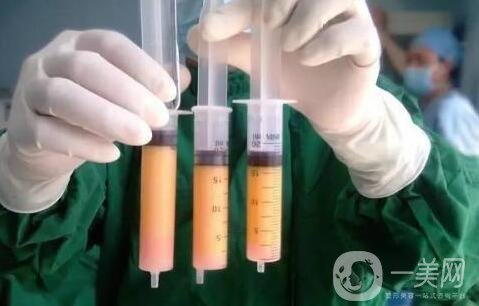 全身抽脂手術(shù)要多長時(shí)間，會(huì)全麻嗎?