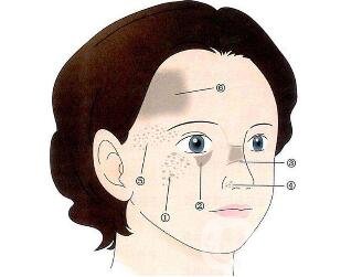 祛斑手術(shù)價格貴不貴？要多少錢？