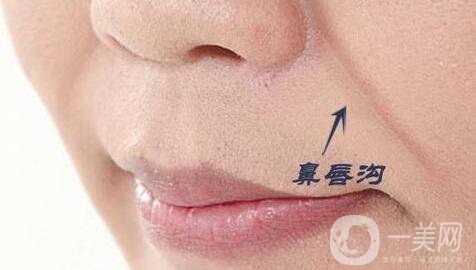 玻尿酸豐鼻唇溝能維持多長時間?