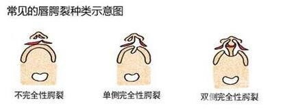 唇裂手術(shù)多少錢?一般唇裂手術(shù)要多少錢?