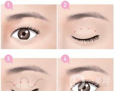 *需要拆線嗎？多長時間可以碰水？