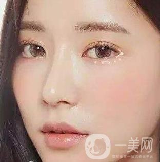 *需要拆線嗎？多長時間可以碰水？