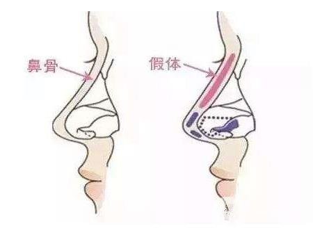 假體隆鼻整型術(shù)術(shù)前準(zhǔn)備有哪些？