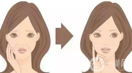 頸部除皺提升術