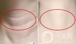 頸部除皺提升術