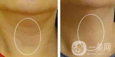 頸部除皺提升術