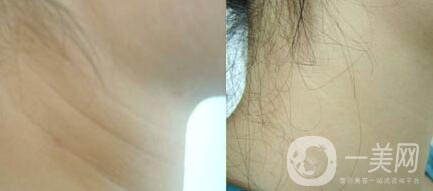 頸部除皺提升術