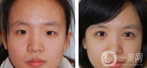 開(kāi)眼角手術(shù)